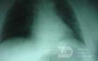 Large Gastric Varices (23 of 25)