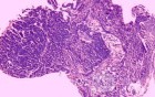 Heterotopic Pancreas with large Central Hole (5 of 6)