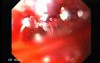 Perforation of a Esophageal Carcinoma after the procedure with hydrostatic balloon dilation (2 of 12)
