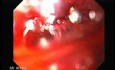 Perforation of a Esophageal Carcinoma after the procedure with hydrostatic balloon dilation (2 of 12)