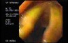 Larynx with ictericia (yellowish color)