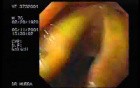 Larynx with ictericia (yellowish color)