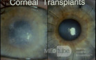 Pre and Post Corneal Transplant
