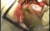 Esophageal Cancer Surgery
