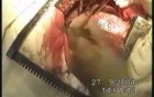 Esophageal Cancer Surgery