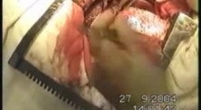 Esophageal Cancer Surgery