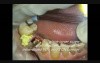 Implant Microsurgery: Replacing Retained Deciduous Molar
