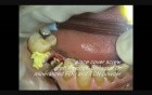 Implant Microsurgery: Replacing Retained Deciduous Molar