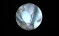 Endometrial ablation in adenomyosis II