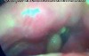 Right vocal fold detachment