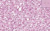 Liver - Fatty Change