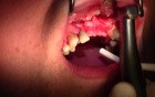 Minimally Invasive Ridge Augmentation, #8-10 Sites