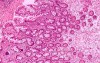 Intestinal Metaplasia of the Pre-Piloric Antrum. Chronic gastritis with intestinal metaplasia (2 of 3)