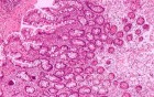 Intestinal Metaplasia of the Pre-Piloric Antrum. Chronic gastritis with intestinal metaplasia (2 of 3)