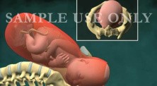 Childbirth - Normal Vaginal Delivery With Pelvic Outlet View