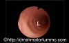 Bronchial Wall Contraction