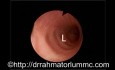Bronchial Wall Contraction