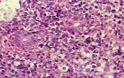 Non-Hodgkin's Lymphoma of the Colon (13 of 16)