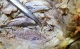 Recurrent Laryngeal Nerve Forms