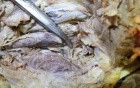 Recurrent Laryngeal Nerve Forms