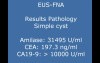 Technical aspects of EUS alcoholization of cystic tumor