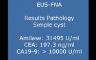 Technical aspects of EUS alcoholization of cystic tumor