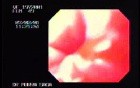 Endoscopic Image of Achalasia