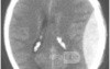 Epidural Hematom