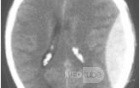 Epidural Hematom
