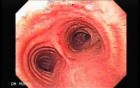 Bronchoscopy 