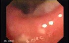 Colonic Tuberculosis Mimicking Crohn's Disease (1 of 12)