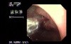 Gastric Adenocarcinoma - Obstruction 4