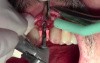 Klipod Recording Of Dental Implant Surgery - #10, Legac