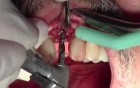 Klipod Recording Of Dental Implant Surgery - #10, Legac