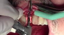 Klipod Recording Of Dental Implant Surgery - #10, Legac