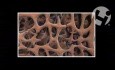 Effects of Accutane on Bone Strength