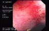 Radiation Proctosigmoiditis (8 of 14)