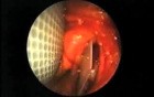 Repair Of Orbital Floor Fracture