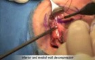 Three Wall Orbital Decompression For Thyroid Eye Disease