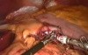 Gastric Bypass for Obesity Treatment