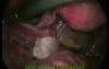 Hysteroscopy and Laparoscopy Performed for Diagnostic Purposes