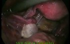 Hysteroscopy and Laparoscopy Performed for Diagnostic Purposes