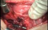 Perforation of a Esophageal Carcinoma after the procedure with hydrostatic balloon dilation (5 of 12)