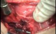 Perforation of a Esophageal Carcinoma after the procedure with hydrostatic balloon dilation (5 of 12)