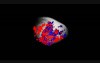 DOPPLER 3DUS CHORIOCARCINOMA