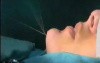 Chin enhancement - Immediate effect