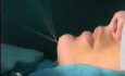 Chin enhancement - Immediate effect
