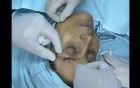 Brow lift using Serdev Suture