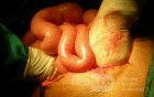 Volvulus Of Small Intestine