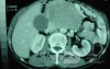 Gastric Ulcer with Gastrocolic fistula due to a Zollinger-
 Ellison Syndrome (29 of 33)